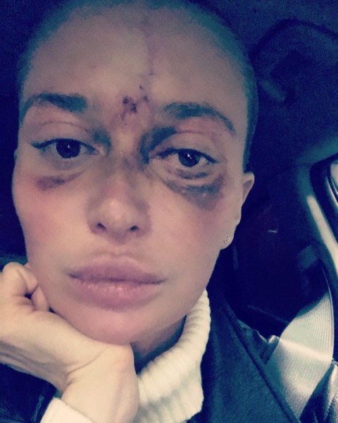 Жительница Москвы потеряла зрение после того, как сходила к косметологу!