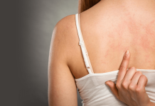 10 основных причин аллергии на коже