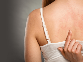 10 основных причин аллергии на коже