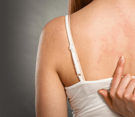 10 основных причин аллергии на коже