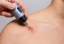 Способы удаления папиллом