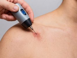 Способы удаления папиллом