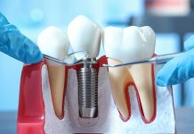 Что такое двухэтапная имплантация зубов и когда необходима?