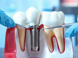 Что такое двухэтапная имплантация зубов и когда необходима?