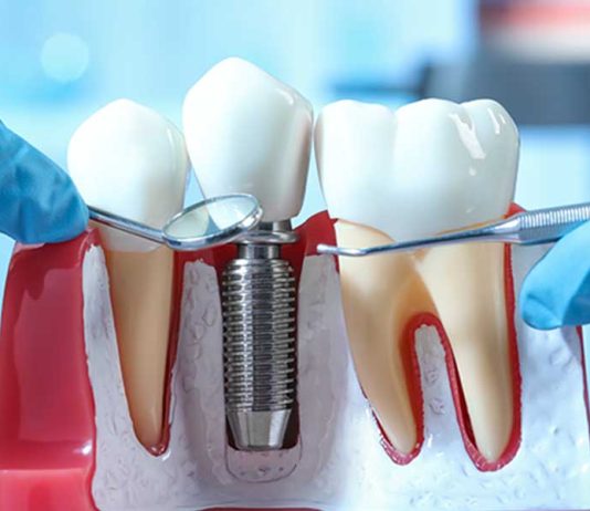 Что такое двухэтапная имплантация зубов и когда необходима?