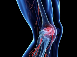 Диагностика тромбофлебита: когда и как её проводить для эффективного лечения