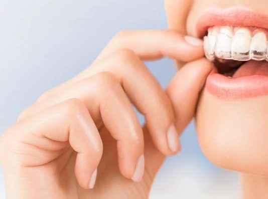 Элайнеры 3D Smile: комфортное и незаметное исправление прикуса без брекетов