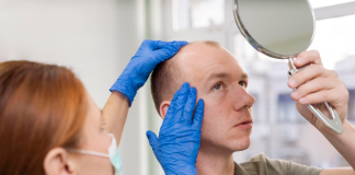 Пересадка бакенбардов: современный способ подчеркнуть мужской стиль